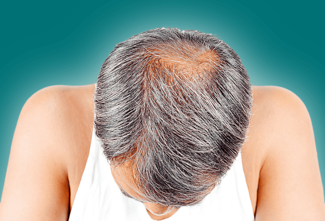 Is a Hair Transplant the Best Solution for Hair Loss?